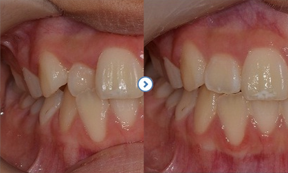 치아교정 전
