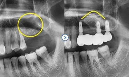 임플란트 전