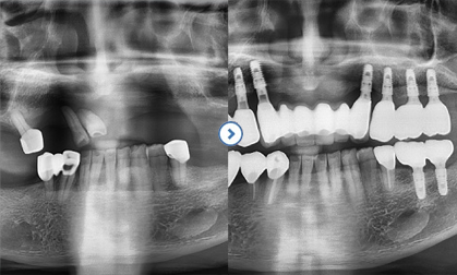 임플란트 후